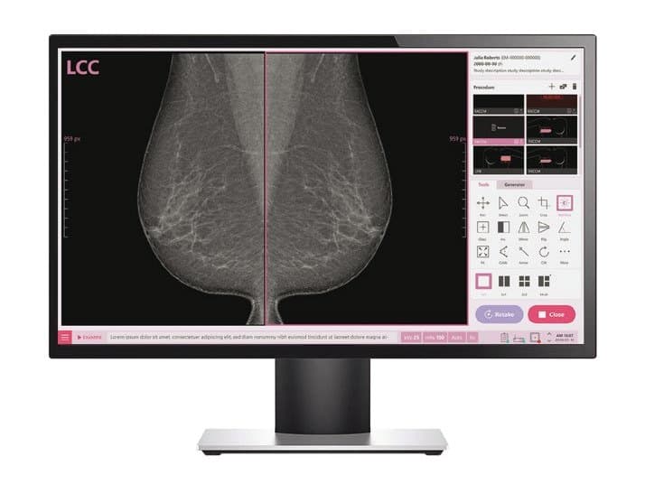 VIVIX-M 1824S / 2430S — Mamografia digital DR (retrofit) — foto 3